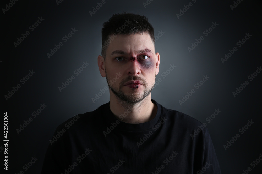 Man with facial injuries on dark background. Domestic violence victim