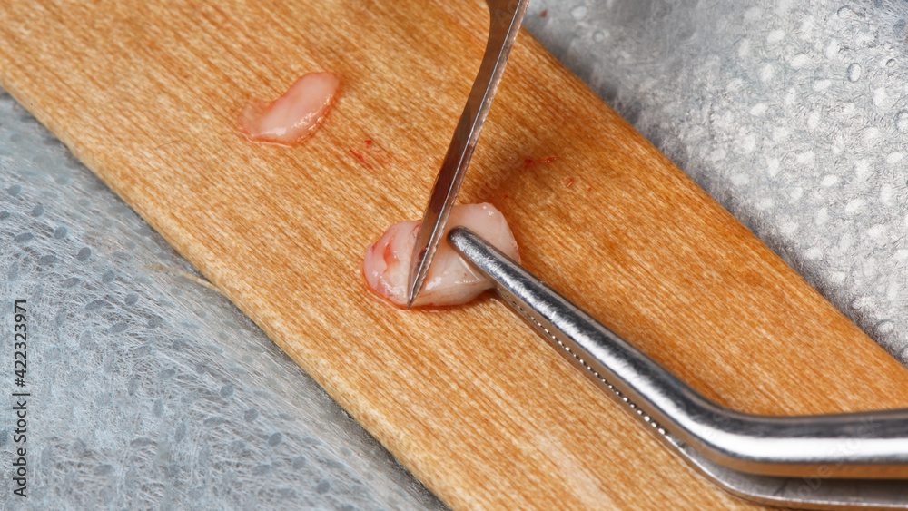 the surgeon prepares a soft tissue flap for the volume of the gums the surgeon prepares a soft tissue flap for the volume of the gums