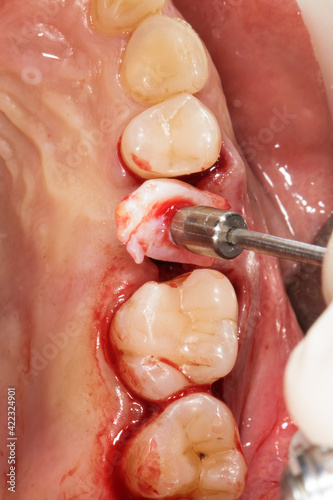 addition of soft tissues and a healing abutment after dental implantation