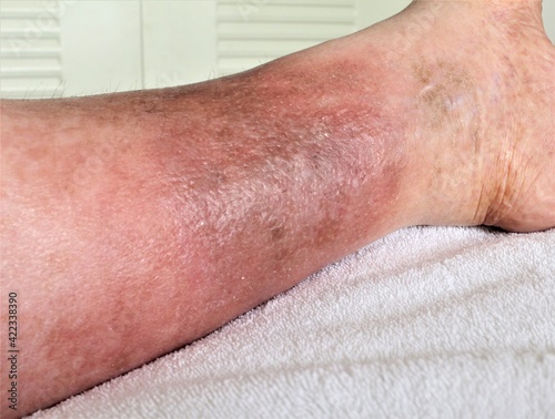 A woman's leg is shown, she is suffering from Chronic Venous Insufficiency with mild cellulitis in her legs. In bed as she rest to relieve heaviness, swelling, pain  redness in the leg.  photo
