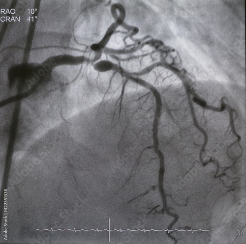 Coronary angiogram (CAG) was performed left coronary artery (LCA) stenosis with aneurysm at proximal left anterior descending artery (LAD).