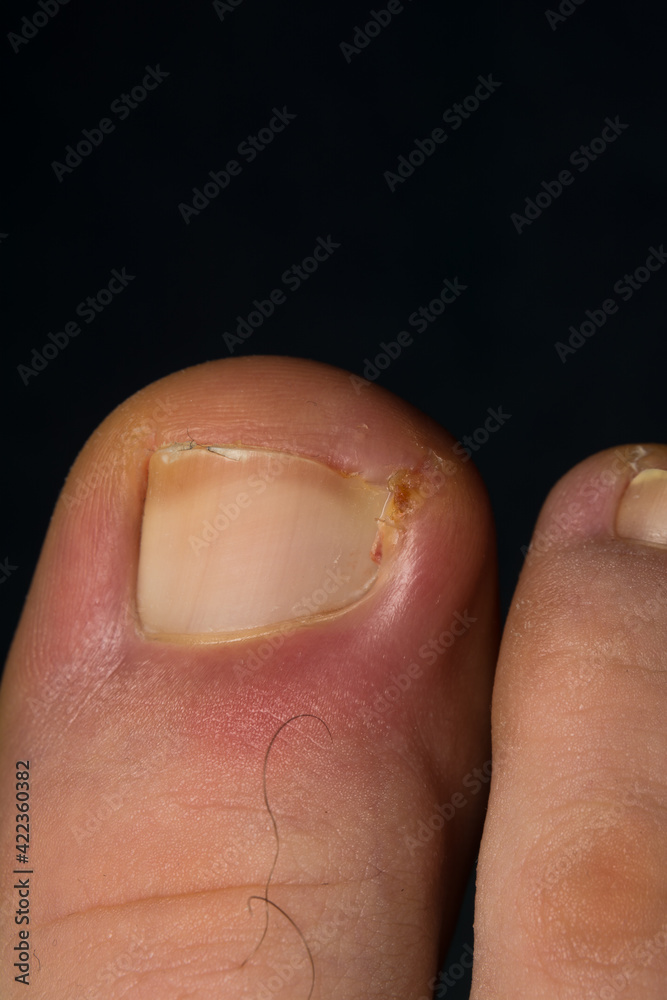 close-up photo of a toenail infection in human close-up photo of a toenail infection in human