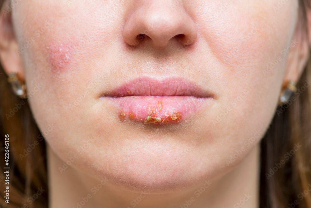 Obraz premium Manifestation of the herpes virus on the lips closeup. Part of a young woman's face with a virus herpes on lips
