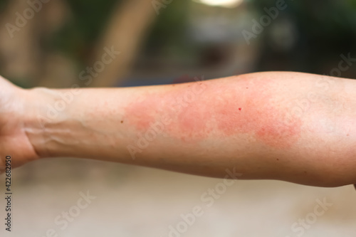 Asian woman has red rash on her right arm