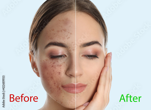 Young woman before and after cosmetic procedure on light background photo