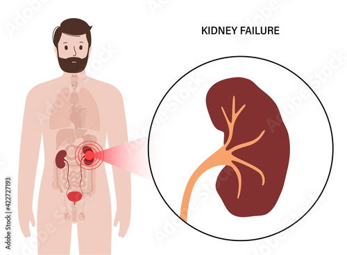 Kidney disease concept