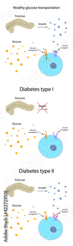 Diabetes type 1, 2, healthy transportation comparison. Pancreas, insulin receptor, glucose transporter, cell.