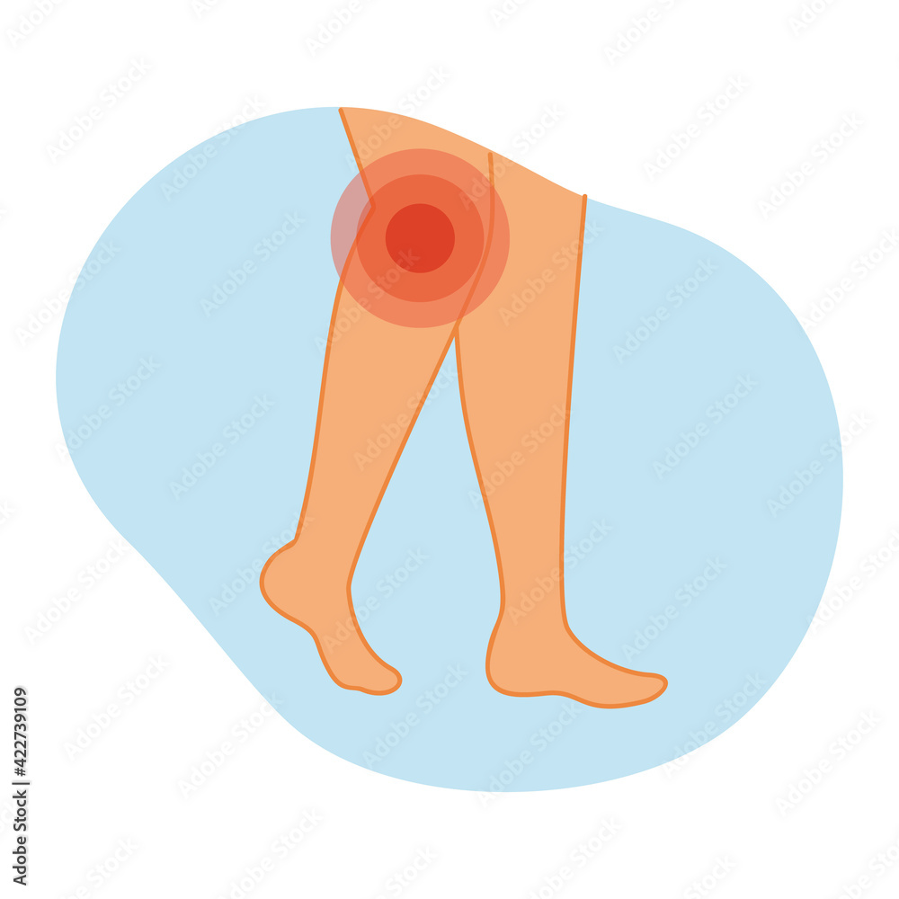 Arthritis of the knee joint. Vector illustration of legs with inflammation in the knee area. Diseases of the musculoskeletal system. Arthritis of the knee joint. Vector illustration of legs with inflammation in the knee area. Diseases of the musculoskeletal system.