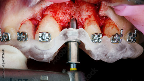 surgical template on braces and a burr for central implantation photo