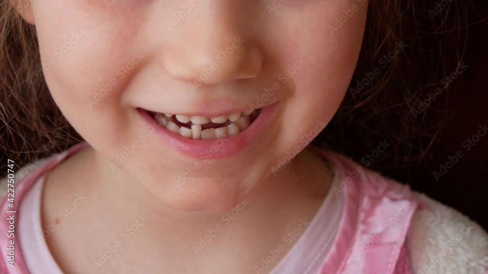 Cute preschooler child wobbling her lower milk tooth and smiling. Deciduous tooth replacement by permanent 4k footage dark background. Scared little girl 6-7 years old has lost incisor. Cute preschooler child wobbling her lower milk tooth and smiling. Deciduous tooth replacement by permanent 4k footage dark background. Scared little girl 6-7 years old has lost incisor.