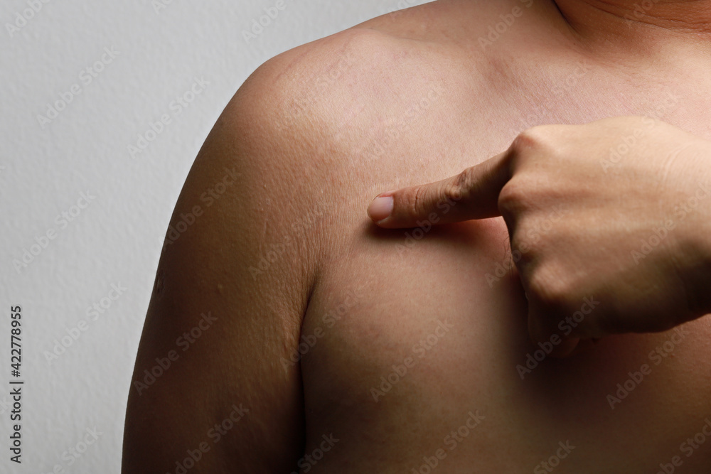 Wunschmotiv: Body striae, stretch marks on an Asian adult arm. #422778955