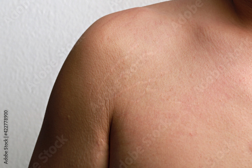 Body striae, stretch marks on an Asian adult arm.