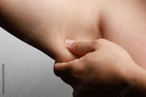 Body striae, stretch marks on an Asian adult arm.