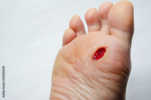 Close up foot after surgery to remove verruca. Injury feet. Bleeding wound. Podology: removal of warts. Caucasian adult woman's foot. Dermatological procedure.