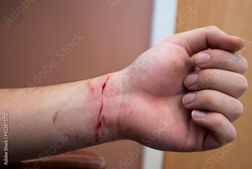 Fototapeta Close up of a cut on a person's wrist