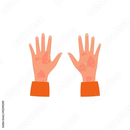 Allergic itching, skin inflammation, redness and irritation. Atopic dermatitis, eczema, psoriasis, dry skin. Skin problems Concept. Two hands  isolated, vector.