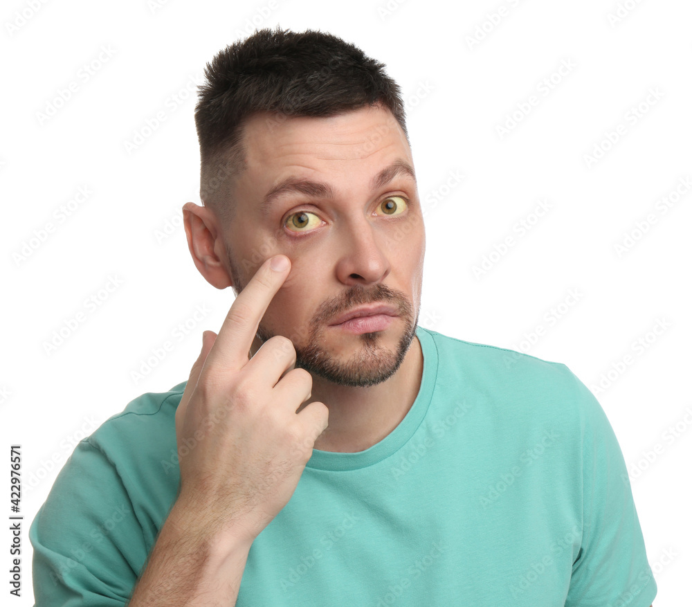 Man checking his health condition on white background. Yellow eyes as symptom of problems with liver Man checking his health condition on white background. Yellow eyes as symptom of problems with liver