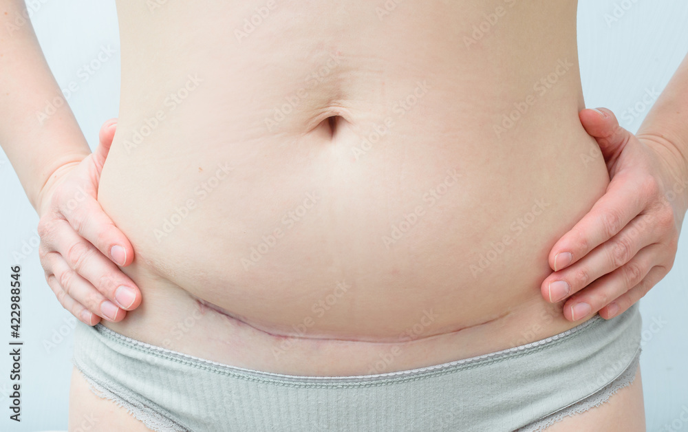 Closeup of woman belly with a scar from a cesarean section on blue background. Closeup of woman belly with a scar from a cesarean section on blue background.