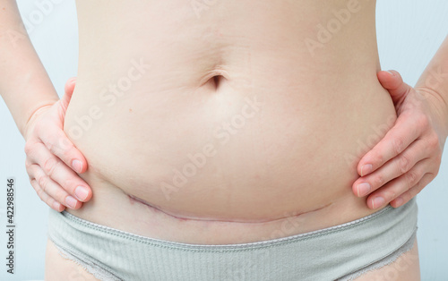 Bilde på lerret Closeup of woman belly with a scar from a cesarean section on blue background