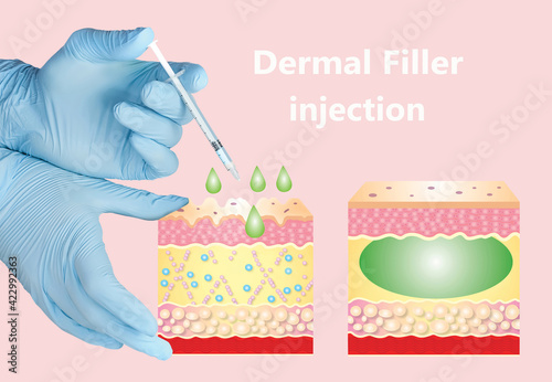 Cosmetic filler or dermal fillers