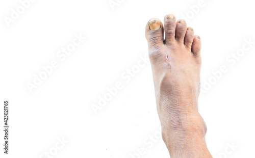 Dirty feet