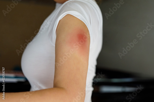 Vaccination reaction on arm of woman after injection of covid corona virus vaccine. Swollen part, red puncture site. Unrecognizable person. photo