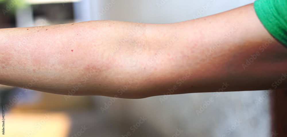 Woman has red rash on her right arm Woman has red rash on her right arm