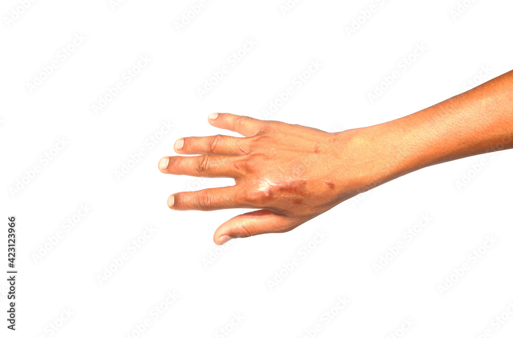 The scar on the hand against the white background