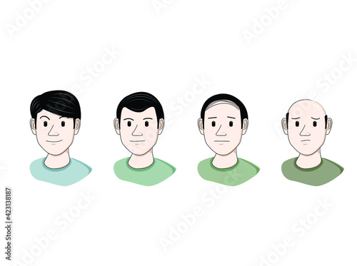 Alopecia stages set. Hair loss, balding process.