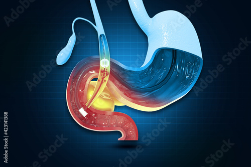 Картината върху платно Gallstones removing the gallbladder. 3d illustration