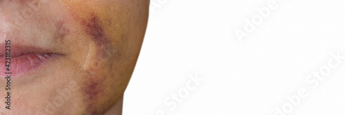Woman face with bruises in the face, text space photo