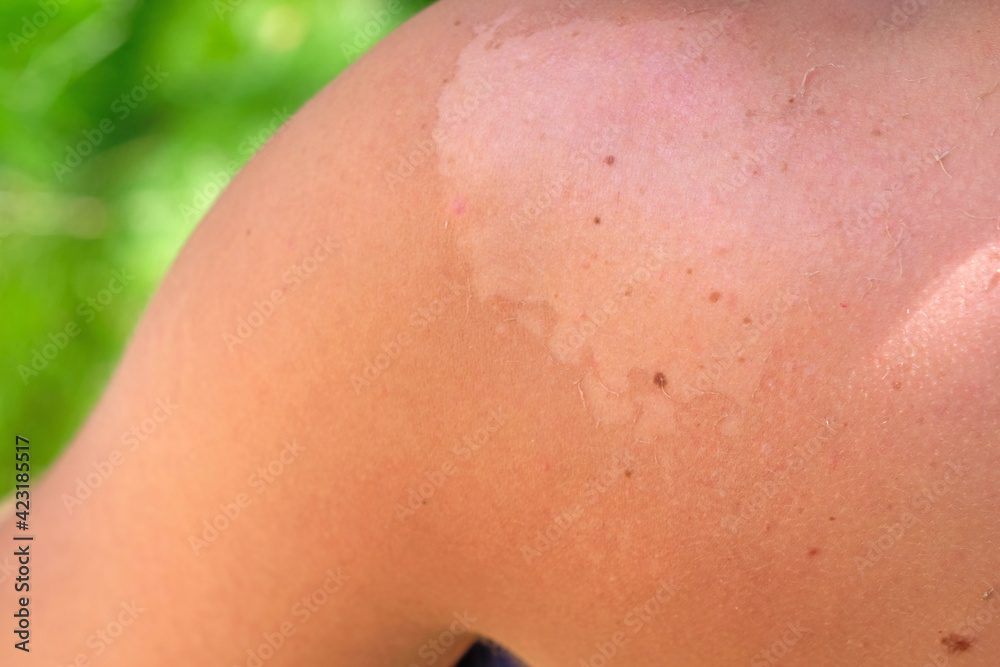 The skin on the shoulder was burnt in the sun close-up. A man's shoulder with peeling skin after sunburn in summer. The skin on the shoulder was burnt in the sun close-up. A man's shoulder with peeling skin after sunburn in summer.