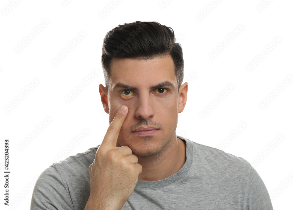 Man checking his health condition on white background. Yellow eyes as symptom of problems with liver Man checking his health condition on white background. Yellow eyes as symptom of problems with liver