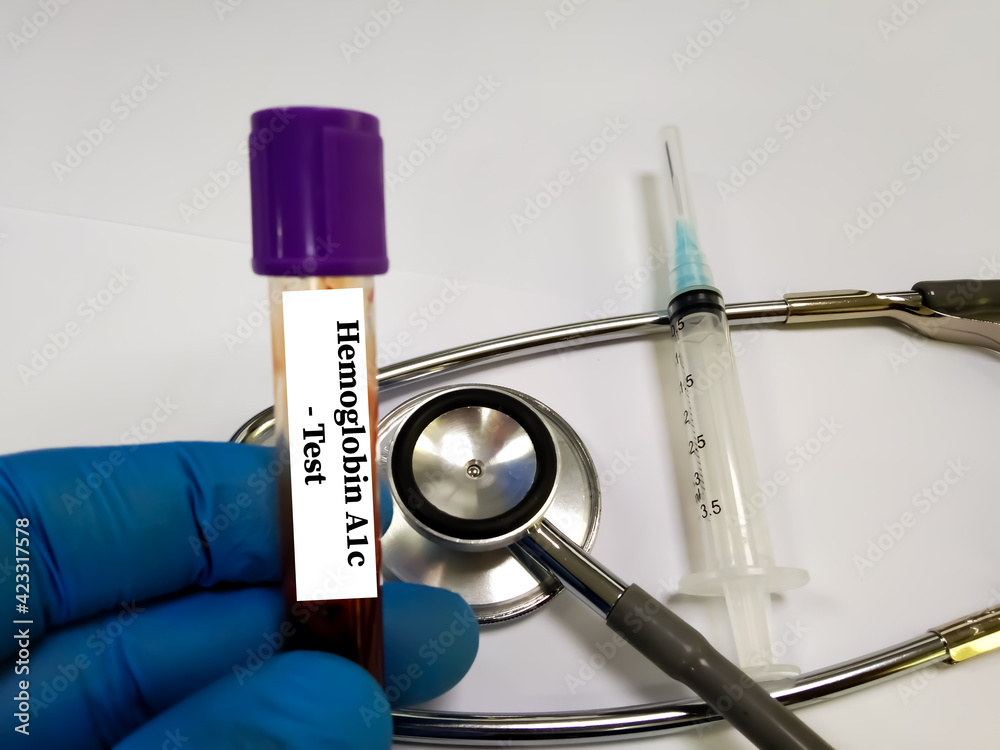 Biochemist hold a syringe with Pleural fluid sample, which is ready for