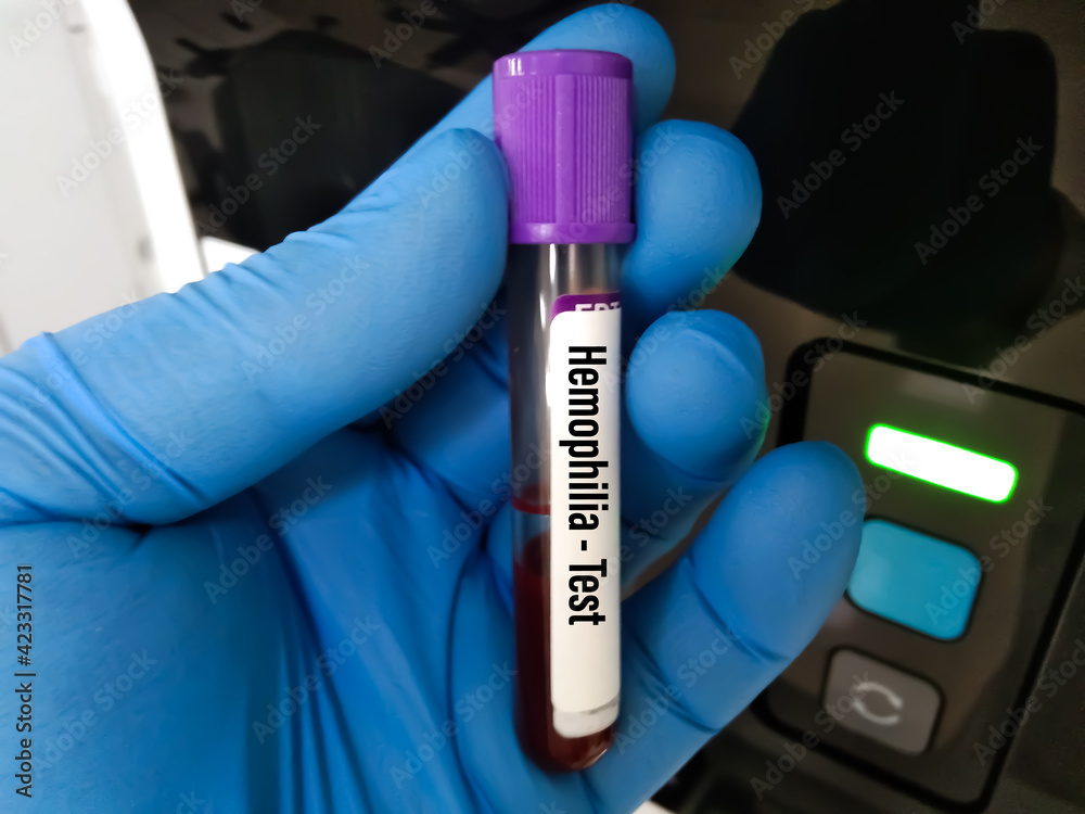 The blood in EDTA tube for test complete Blood Count (cbc) testing hematology laboratory
