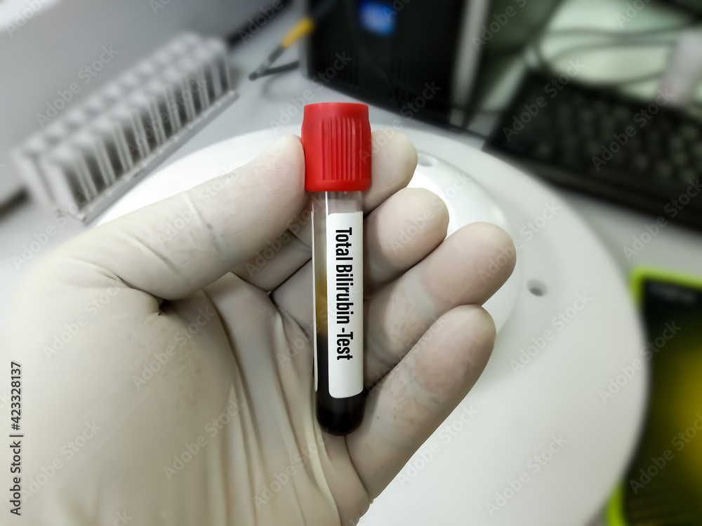 Scientist hold blood sample for Total Bilirubin test. Jaundice