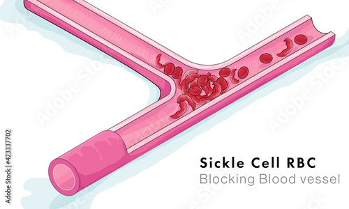 Sickle cell Red blood cells blocking blood vessel.