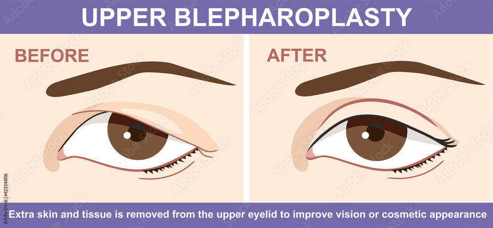Blepharoplasty of eyelid , before and after. Vector illustration with double eyelid surgery. Infographics with icons of plastic surgery procedures. - obrazy, fototapety, plakaty 
