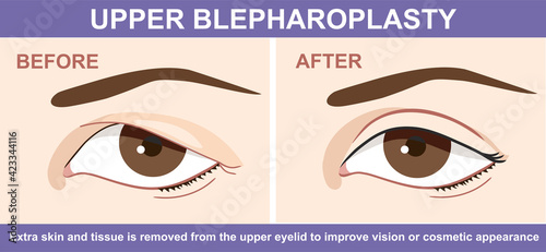 Blepharoplasty of eyelid , before and after. Vector illustration with double eyelid surgery. Infographics with icons of plastic surgery procedures. photo