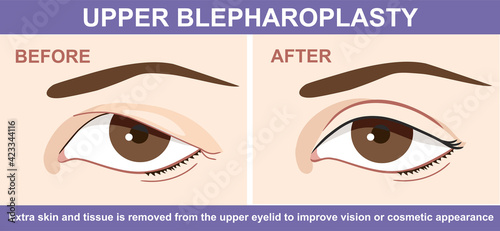 Blepharoplasty of eyelid , before and after. Vector illustration with double eyelid surgery. Infographics with icons of plastic surgery procedures.