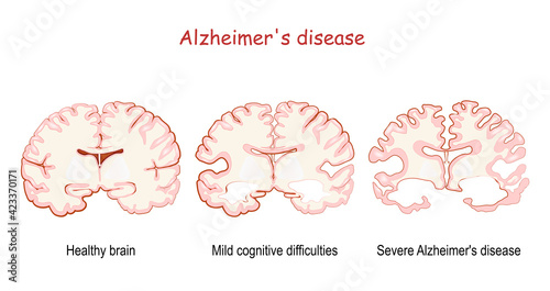 Alzheimer