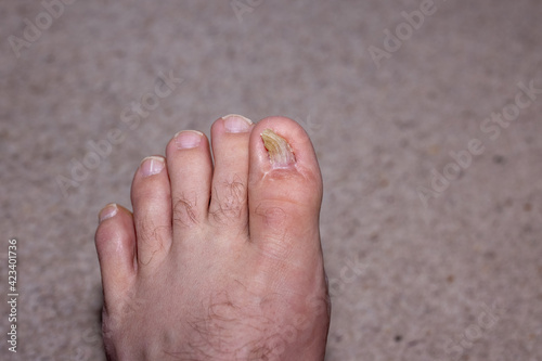 Aftermath of surgey to repair an ingrown toenail