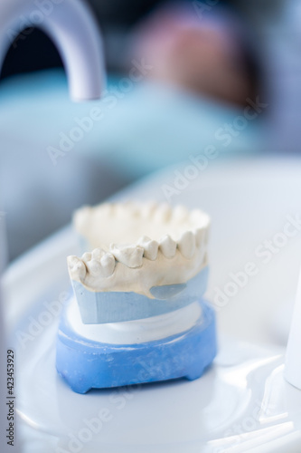 Plaster cast of the jaw in the dentist's office
