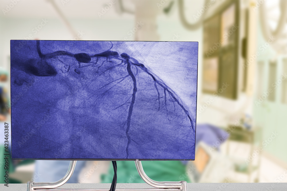 Cardiac Catheterization with Coronary Angiography on blurry Angiography