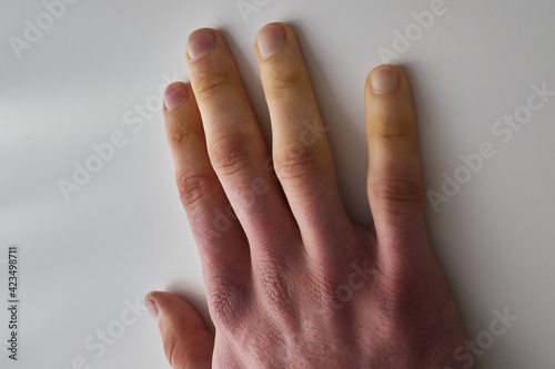 white fingers from the cold, poor blood circulation,close up
