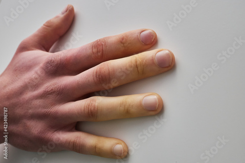 white fingers from the cold, poor blood circulation,close up photo