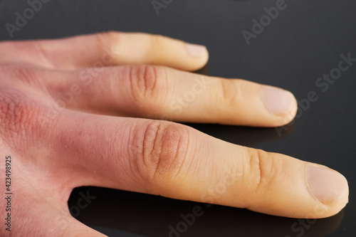 white fingers from the cold, poor blood circulation,close up photo