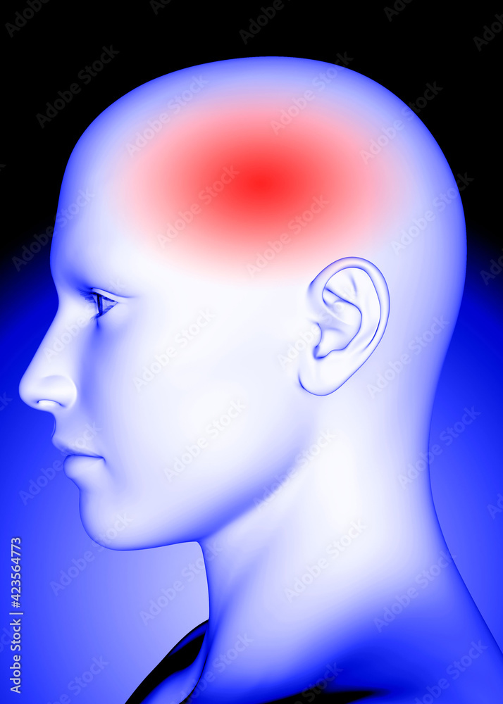Headache - 3D Headache - 3D