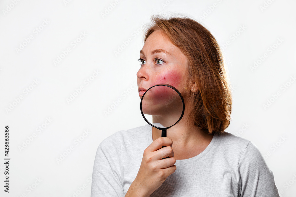 The concept of rosacea. Portrait of a caucasian woman showing redness on her cheeks, with a magnifying glass. Copy space. White background The concept of rosacea. Portrait of a caucasian woman showing redness on her cheeks, with a magnifying glass. Copy space. White background