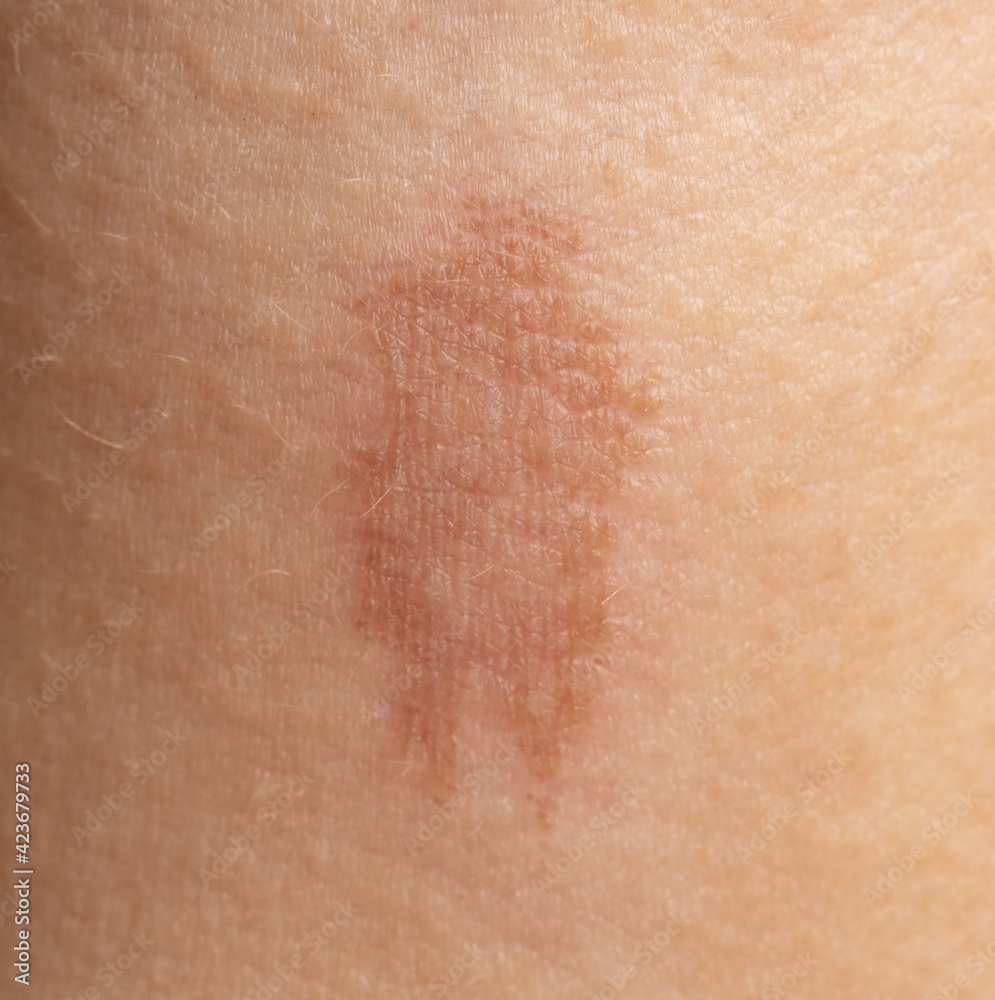 Fototapeta premium round skin burns from hot oil